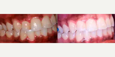 Man treated with Invisalign - Patient presented with a chief complaint of uneven teeth and poor midline due to relapse after wisdom teeth eruption. Invisalign treatment was completed in 7 months using the accelerated Propel technique.