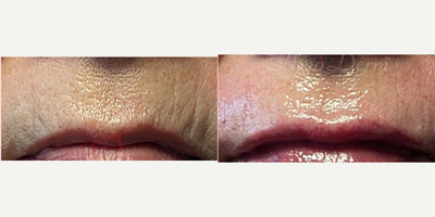 65-74 year old woman treated with Restylane, Restylane Silk, Juvederm - Treatment for smoker's lines above upper lip with filler injection (Juvederm, Belotero, Restylane Silk)