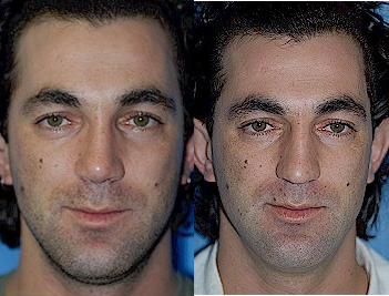 Man treated with Septoplasty and Rhinoplasty - Man treated with Septoplasty and Rhinoplasty