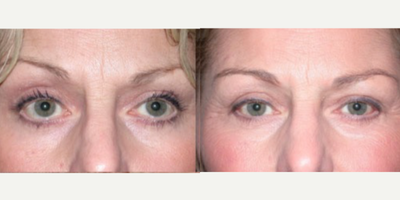 Eyelid Retraction Repair - This woman had a poor outcome to her previous lower lid surgery (by another surgeon) with lower lids which pulled down (retracted) allowing the white to show under the iris (colored part of the eye). This is called scleral show and makes the person look wide-eyed. After revisional surgery (cheek lift, canthoplasty, lid elevation) she is much improved.