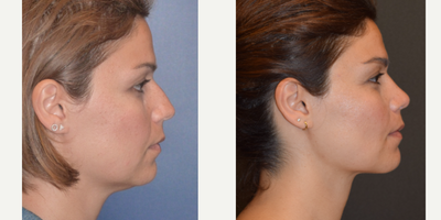 35-44 year old woman treated with Rhinoplasty - 35 years old female, complaining about her nose, cheek fullness and stubborn fat on her neck. I performed rhinoplasty, buccal fat removal and vaser neck liposuction. She had deviation, hump and breathing problems as well. We got with rhinoplasty natural and fantastic result and fixed the airway. Buccal fat removal address the medial cheek fullness, via intraoral approach. Careful excision should be performed. Over excision may cause hollowing appearence. During Vaser neck liposuction means we use ultrasound energy to melt the fat while protecting surrounding tissues and helps to get better result than traditional liposuciton.