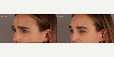 Upper Facial Botox (Forehead, 11's, Crows Feet) - 29-year-old female who requested conservative Botox treatment to address upper facial wrinkles of expression. Conservative dosing was used to preserve facial movement but reduce wrinkling. She is shown two weeks post-treatment.