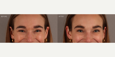 Upper Facial Botox (Forehead, 11's, Crows Feet) - 29-year-old female who requested conservative Botox treatment to address upper facial wrinkles of expression. Conservative dosing was used to preserve facial movement but reduce wrinkling. She is shown two weeks post-treatment.