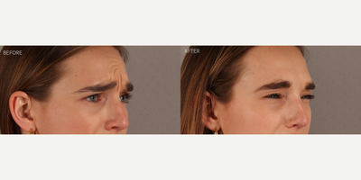 Upper Facial Botox (Forehead, 11's, Crows Feet) - 29-year-old female who requested conservative Botox treatment to address upper facial wrinkles of expression. Conservative dosing was used to preserve facial movement but reduce wrinkling. She is shown two weeks post-treatment.