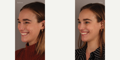 Upper Facial Botox (Forehead, 11's, Crows Feet) - 29-year-old female who requested conservative Botox treatment to address upper facial wrinkles of expression. Conservative dosing was used to preserve facial movement but reduce wrinkling. She is shown two weeks post-treatment.