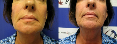 Woman treated with Renuva - Woman treated with Renuva.