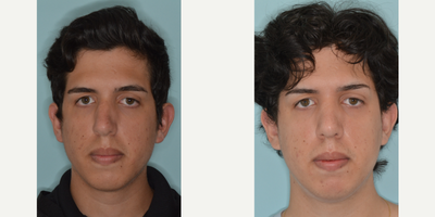25-34 year old man treated with Rhinoplasty - Before and after of a patient with a crooked nose.