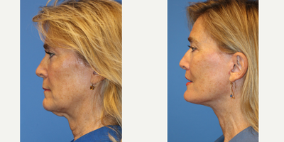 55-64 year old woman treated with Facelift, Laser Genesis, Lip Lift - This is a 62 year old female otherwise healthy with signs of facial ageing including elongation of the upper lip, skin laxity of the face and neck causing jowling, loss of the cervicomental (chin/neck) angle, platysma banding, soft tissue descent of the midface, nasolabial folds. The patient underwent deep plane facelift, lip lift. Photos are before and 5 months post op. The patient underwent post op facelift protocol including lymphatic massage, laser genesis and scar cream application to enhance/ accelerate her healing process.