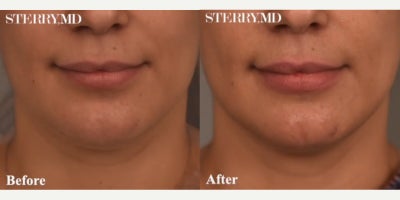 Woman treated with Chin Liposuction - Woman treated with Chin/Neck Liposuction