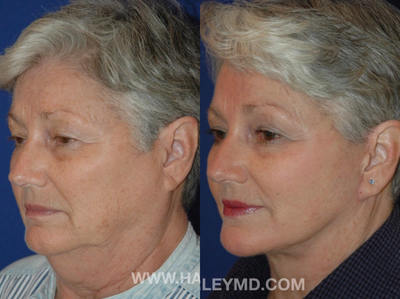 65-74 year old woman treated with Neck Lift - Face and neck lift under local anesthesia.