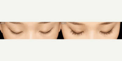 Woman treated with Latisse - Woman treated with Latisse, shown 16 weeks post op.