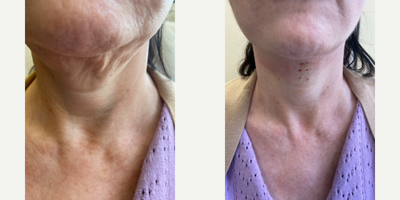 55-64 year old woman treated with Thread Lift - PDO threads when used and placed correctly , produce natural long lasting results.