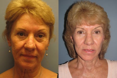 This 62-year-old woman had a LiteLift, Temple Lift, and Blue Peel - 	This 62-year-old woman received the LiteLift, Temple Lift, and Blue Peel resulting in a beautiful, natural look. Notice in her post-op photos a now refreshed, rejuvenated and rested appearance.