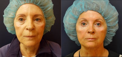 69 Year Old Female Before/After Ultherapy X2. 12 Months After (note, patient had a face lift 11 years earlier) - 	This patient had mild lower face aging and more upper face aging. She was interested in a non-invasive treatment. She underwent 2 Ultherapy treatments (full face) spaced 6 months apart. Photo is 12 months later.