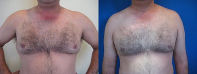 Laser Liposuction - Gynecomastia - 
	Laser Liposuction - Gynecomastia
