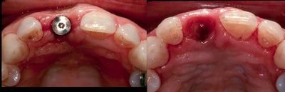 Gum Graft Around Implant - Here is a gum graft around implant before-and-after photo from one of my patients.