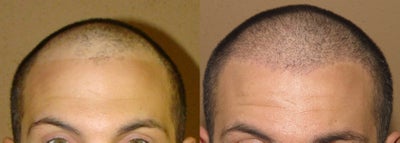 ARTAS robotic hair transplantation - robotic hair transplantation using FUE technique - robotic assisted