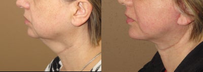 Neck lift  - 
	Neck lift with tightening of the platysma muscle
