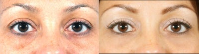 Filler for Under-eye circles (tear troughs) - 	Tired appearing eyes with shadows in the tear troughs can be treated easily with fillers such as Restylane, or Teosyal (Redensity II). The tear troughs are filled in to reduce the dark circles and the pigment and freckling are treated with a superficial chemical peel to create a fresher, more well-rested appearance.