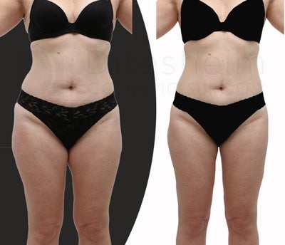 Body-jet (water liposuction) liposuction for lower body - 
	43 yr old woman wanted better body proportion, less saddlebags on thighs. Before and 6 months after body-jet (water liposuction). Her clothes size changed from 6 to 2-4. her weight at 6 months 3 lbs less than preop.
