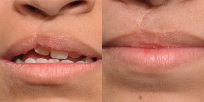 17 or under year old woman treated with Cleft Lip Revision - Teenage cleft lip revision using buccal fat graft.