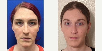 Patient treated with Rhinoplasty, Septoplasty - Septorhinoplasty with Cartilage Grafts and Weirs - 35 to 44 year-old female patient is 6 months post-op from Facial Feminization surgery. Her procedures included: Hairline Forehead Lift, Hairline Lowering, Orbital Bony Contouring, Chin Reduction and Contour, Thyroid Cartilage Shave, Voice Feminization, Cheek Implants (small), Subnasal Lip Lift with Fat Augmentation to Lips, and Septorhinoplasty (closed) with Cartilage Grafts.