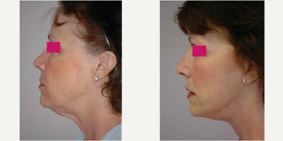 Neck Lift - Neck Lift