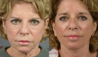 55-64 year old woman treated with Facelift - Facelift before and after