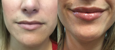 35-44 year old woman treated Volbella - Patient was treated with 1 syringe of Juvederm Volbella to lift, and define the lips while giving them subtle volume.