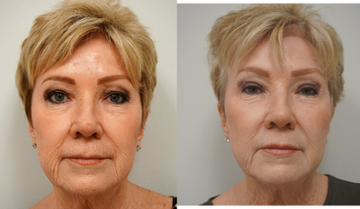 65-74 year old woman treated with Renuvion - Full face J Plasma (Renuvion) skin resurfacing with fat grafting and upper blepharoplasty