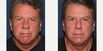 61 year old man treated with Photodynamic Therapy - Male patient is treated with Photodynamic therapy for facial redness and CO2 laser for rhinophyma.