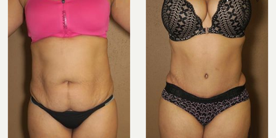 Woman treated with Liposuction - Woman treated with Tummy Tuck combined with liposuction