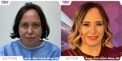 35-44 year old woman treated with Mini Facelift, Buccal Fat Removal, Facial Fat Transfer, Chin Liposuction - This patient was treated with Mid-facelift combined with other procedures :Neck Liposuction, Buccal fat removal, liposuction in the chin, and facial fat transfer into the upper part of the face.