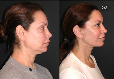 Rhinoplasty Before and After - Dr. Andrew Jacono