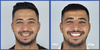 25-34 year old man treated with Smile Makeover, Porcelain Veneers, Full Mouth Reconstruction - Our patient visited our clinic from another city. He wanted to have a beautiful smile. We applied full mouth zirconia crowns and repaired all necessary teeth. All design was performed digitally.