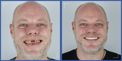 35-44 year old man treated with All-on-4 Dental Implants, Smile Makeover, Full Mouth Reconstruction - Our patient had a trauma in the past and lost his anterior teeth. In addition his gum disasease caused all his tooth roots to erupt and most of them were mobile. Our doctors extracted unhealthy teeth and applied All-on-6 implant treatment to both upper and lower jaw. Applied fixed overdentures were made of zirconia material.