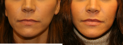 Lip lift - Lip Lift