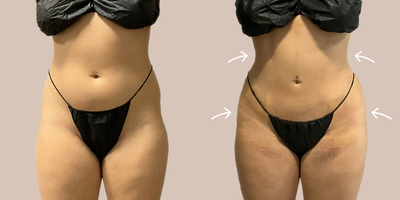 35-44 year old woman treated with AirSculpt - Patient received stomach airsculpt and then transferred the fat to their hips in our Austin location.
