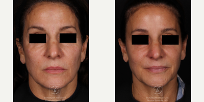 45-54 year old woman treated with Vivace - Vivace for skin tightening and improvement of fine lines and wrinkles.