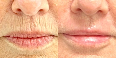55-64 year old woman treated with Lip Surgery - Patient wanted to have bar code lines removed from upper lip.  This is accomplished with dermabrasion.