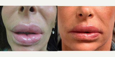 45-54 year old woman treated with Lip Lift and Lip Reduction - 50 year old woman treated with Lip Lift and Lip ReductionHeight: 510 Weight: 119 pounds BMI: 17.1 Time After Surgery: 7 MonthsGoals: she had silicone placed in her lips 10 years ago and would like the silicone removed, and her upper lip liftedNote: lip lift incision placed within the white roll of the upper lip