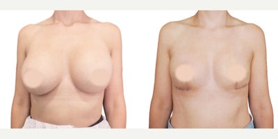 35-44 year old woman treated with Breast Implant Removal, Breast Reconstruction, Breast Lift - Breast implant removal is more than just removing the prosthesis and capsules. It's reconstructive surgery that has aesthetic goals for our patients. The great thing about this surgery is that we can use the patient's tissue for reconstruction, allowing immediate results. Plus, it's almost always painless and leaves an L-shaped scar with no scars in the cleavage area. Thanks to the BRALAN Technique(Breast Reconstruction Anatomical Lift Augmentation), we can achieve a consistent and stable aesthetic result regardless of breast tissue size.