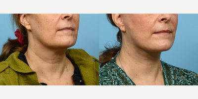 55-64 year old woman treated with HydraFacial - Looking to correct laxity in her lower face, this 55-year-old patient opted for a facelift with Dr. Wise. Although still healing, her results at the six week mark already look fantastic, and she's thrilled with the outcome.
