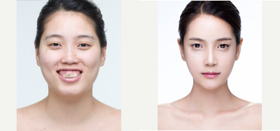 25-34 year old woman treated with Facial Feminization Surgery - Two Jaw surgery, gum osteotomy , and Face contouring for asymmetry correction, and feminine face. 