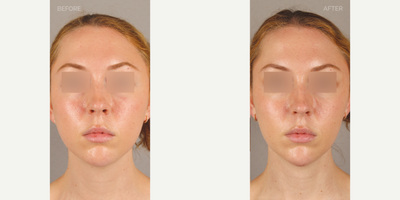 Chin Augmentation Filler with Masseter Botox - 25-year-old female with profile imbalance related to a slightly regressed chin. She also complained of discomfort related to clenching and grinding her teeth, and a widened jaw. She is shown 6 weeks after chin augmentation with filler, and Botox to the masseter muscles for symptom relief and jaw narrowing.
