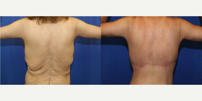 35-44 year old woman treated with Back Lift - This patient was unhappy with the excess skin and fat on her back after weight loss. She desired a flat back. Dr. Katzen was able to remove excess skin and fat off her back by performing an upper body lift (also known as a horizontal torsoplasty). She is very happy with her results.