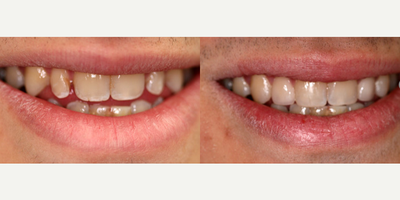 Dental Bonding - 17 year-old male patient complaining of his malformed upper teeth. His orthodontic treatment could not correct for his peg laterals, a common anomaly of shape for those teeth. Using a direct bonding procedure with composite material, Dr. Davidowitz was able to reshape his teeth.