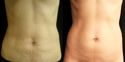 35-44 year old woman treated with Velashape - This 38 year old female had three Velashape treatments, 2 weeks apart.