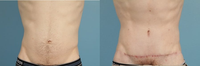 Man treated with Tummy Tuck - Man treated with Tummy Tuck