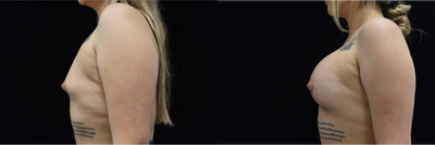 25-34 year old woman treated with Breast Implants - 28 yrs old womanCorrection of Tuberous Breast and augmentation450cc High Profile on the left and 385cc High profile on the rightIn these photos she is 1 month post-op